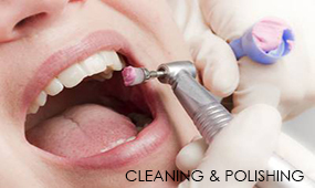 Cleaning & Polishing Of Teeth