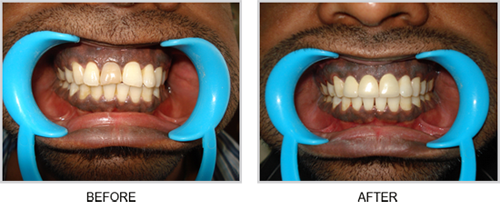 Zirconia Crowns  in Hyderabad