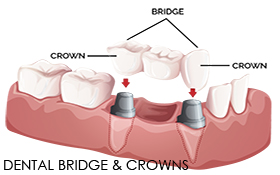 Dental Bridge and Crown