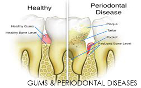 Gums & Periodontal Diseases